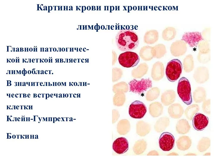 Картина крови при хроническом лимфолейкозе Главной патологичес- кой клеткой является лимфобласт. В значительном