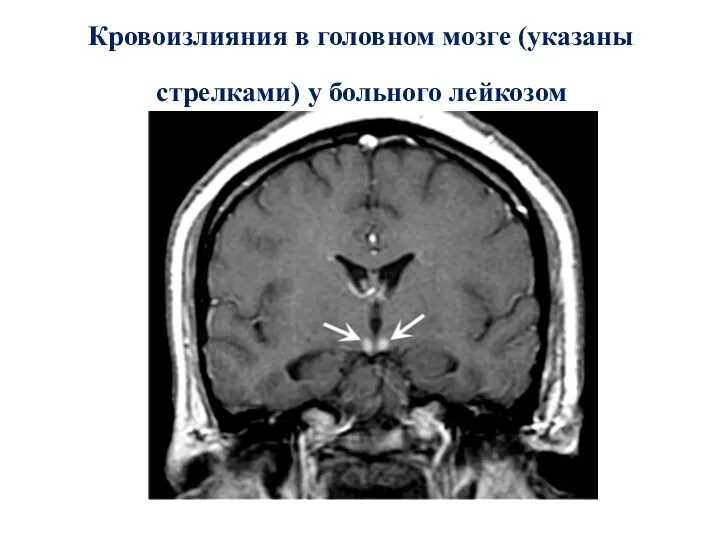 Кровоизлияния в головном мозге (указаны стрелками) у больного лейкозом