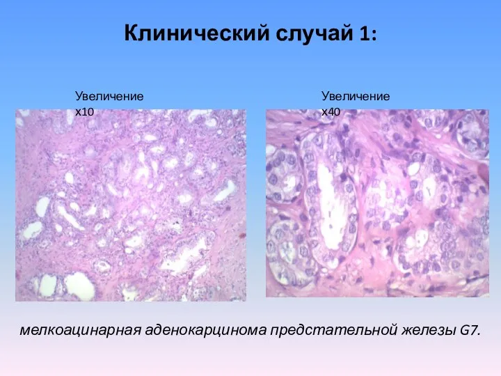 Клинический случай 1: мелкоацинарная аденокарцинома предстательной железы G7. Увеличение х10 Увеличение х40