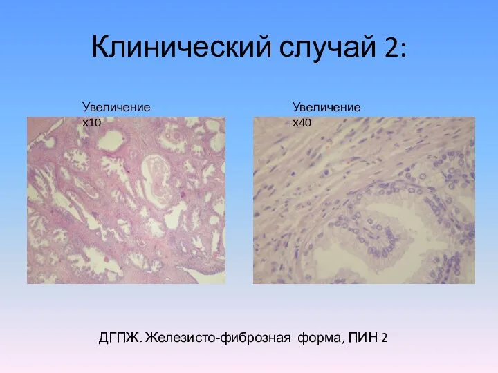 Клинический случай 2: ДГПЖ. Железисто-фиброзная форма, ПИН 2 Увеличение х10 Увеличение х40