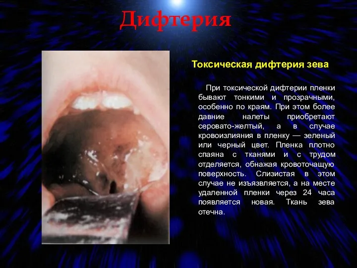 Дифтерия Токсическая дифтерия зева При токсической дифтерии пленки бывают тонкими