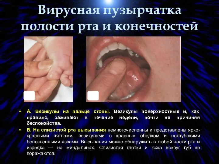 Вирусная пузырчатка полости рта и конечностей А. Везикулы на пальце