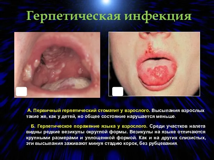 Герпетическая инфекция А. Первичный герпетический стоматит у взрослого. Высыпания взрослых