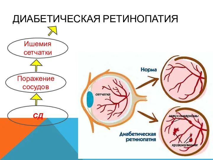 ДИАБЕТИЧЕСКАЯ РЕТИНОПАТИЯ СД Поражение сосудов Ишемия сетчатки