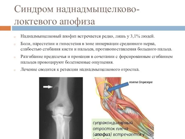 Синдром наднадмыщелково-локтевого апофиза Наднадмыщелковый апофиз встречается редко, лишь у 3,1%