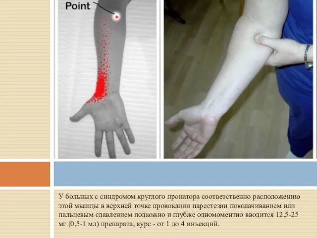 У больных с синдромом круглого пронатора соответственно расположению этой мышцы