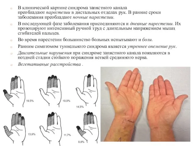 В клинической картине синдрома запястного канала преобладают парестезии в дистальных