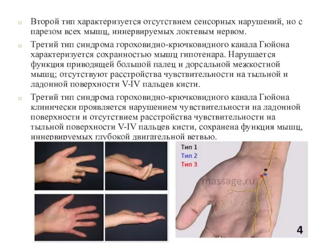 Второй тип характеризуется отсутствием сенсорных нарушений, но с парезом всех