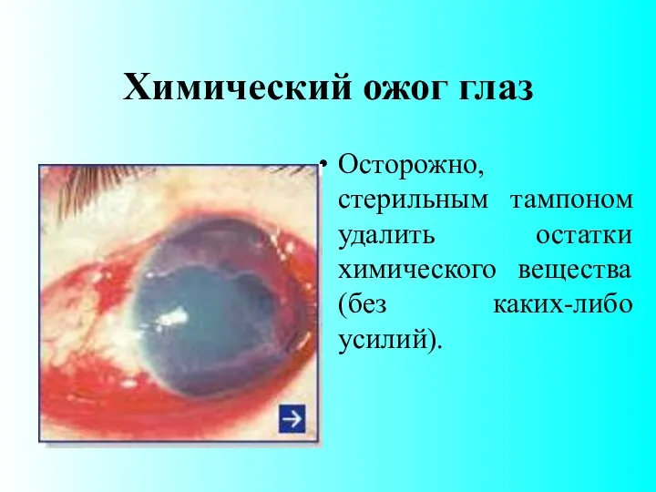 Химический ожог глаз Осторожно, стерильным тампоном удалить остатки химического вещества (без каких-либо усилий).