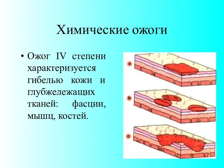 Химические ожоги Ожог IV степени характеризуется гибелью кожи и глубжележащих тканей: фасции, мышц, костей.