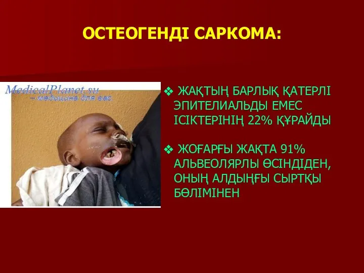 ОСТЕОГЕНДІ САРКОМА: ЖАҚТЫҢ БАРЛЫҚ ҚАТЕРЛІ ЭПИТЕЛИАЛЬДЫ ЕМЕС ІСІКТЕРІНІҢ 22% ҚҰРАЙДЫ