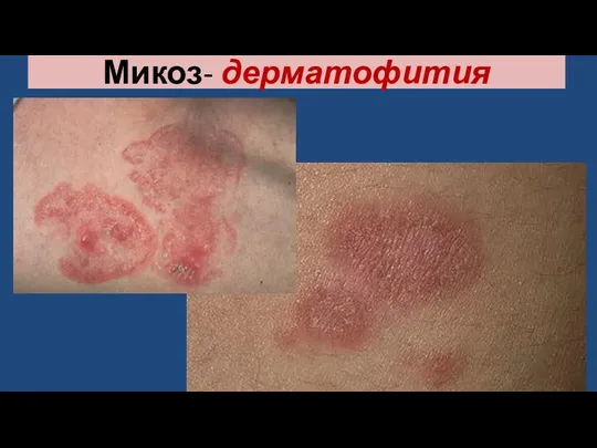 Микоз- дерматофития