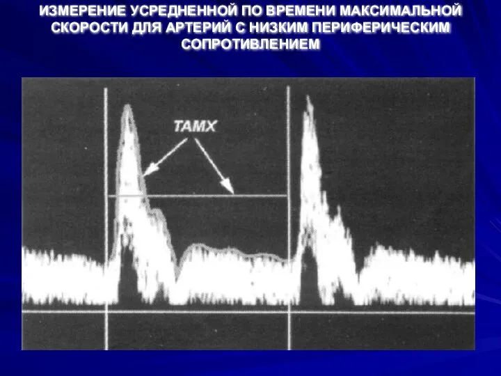 ИЗМЕРЕНИЕ УСРЕДНЕННОЙ ПО ВРЕМЕНИ МАКСИМАЛЬНОЙ СКОРОСТИ ДЛЯ АРТЕРИЙ С НИЗКИМ ПЕРИФЕРИЧЕСКИМ СОПРОТИВЛЕНИЕМ