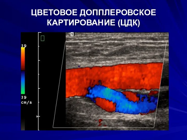 ЦВЕТОВОЕ ДОППЛЕРОВСКОЕ КАРТИРОВАНИЕ (ЦДК)