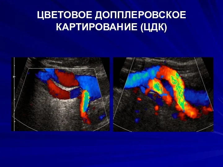 ЦВЕТОВОЕ ДОППЛЕРОВСКОЕ КАРТИРОВАНИЕ (ЦДК)