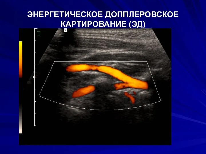 ЭНЕРГЕТИЧЕСКОЕ ДОППЛЕРОВСКОЕ КАРТИРОВАНИЕ (ЭД)