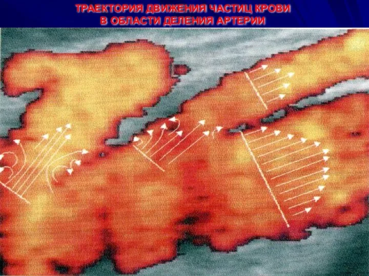 ТРАЕКТОРИЯ ДВИЖЕНИЯ ЧАСТИЦ КРОВИ В ОБЛАСТИ ДЕЛЕНИЯ АРТЕРИИ