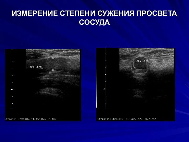 ИЗМЕРЕНИЕ СТЕПЕНИ СУЖЕНИЯ ПРОСВЕТА СОСУДА