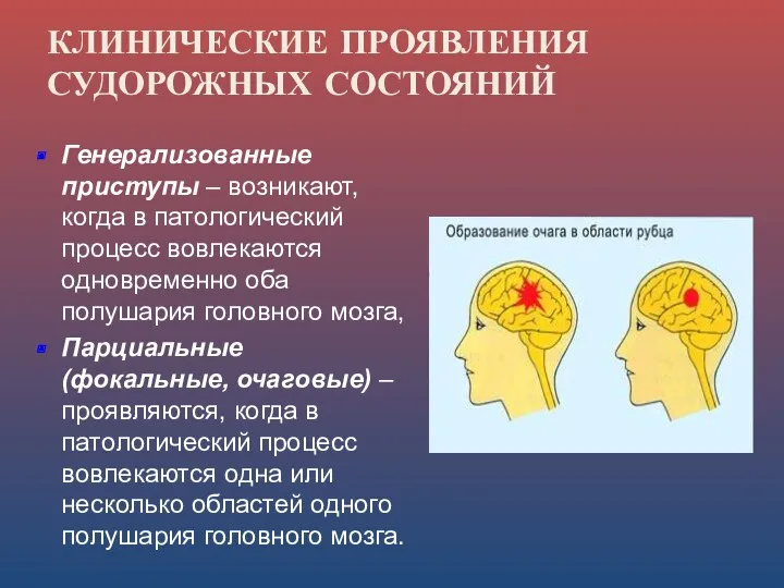 КЛИНИЧЕСКИЕ ПРОЯВЛЕНИЯ СУДОРОЖНЫХ СОСТОЯНИЙ Генерализованные приступы – возникают, когда в