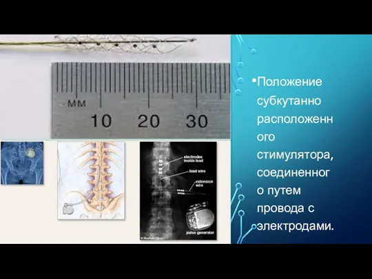 Положение субкутанно расположенного стимулятора, соединенного путем провода с электродами.