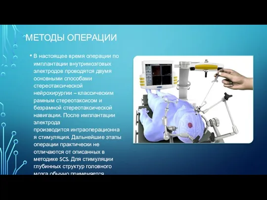МЕТОДЫ ОПЕРАЦИИ В настоящее время операции по имплантации внутримозговых электродов проводятся двумя основными