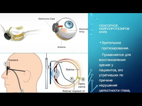 СЕНСОРНОЕ НЕЙРОПРОТЕЗИРОВАНИЕ Зрительное протезирование. Применяется для восстановления зрения у пациентов,