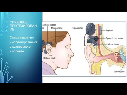 СЛУХОВОЕ ПРОТЕЗИРОВАНИЕ Схема строения имплантированного кохлеарного импланта.