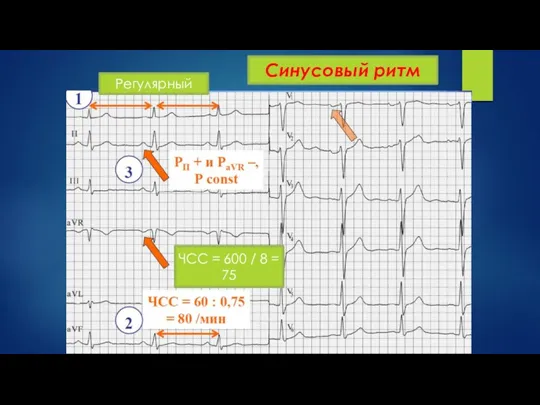 ЧСС = 600 / 8 = 75 Регулярный Синусовый ритм