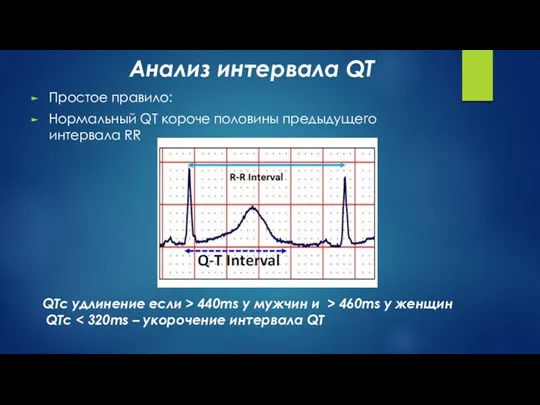 Простое правило: Нормальный QT короче половины предыдущего интервала RR Анализ интервала QT QTc