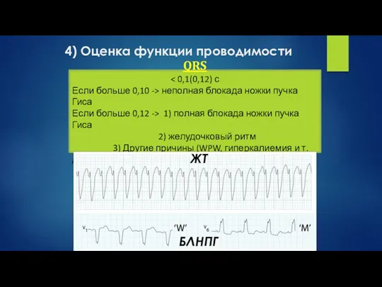 4) Оценка функции проводимости QRS Если больше 0,10 -> неполная