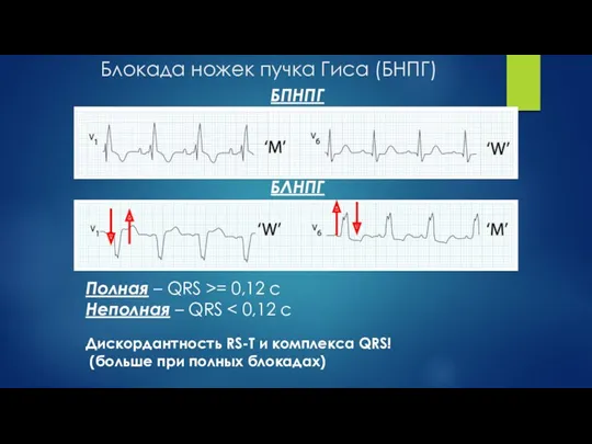 Блокада ножек пучка Гиса (БНПГ) БПНПГ БЛНПГ Полная – QRS