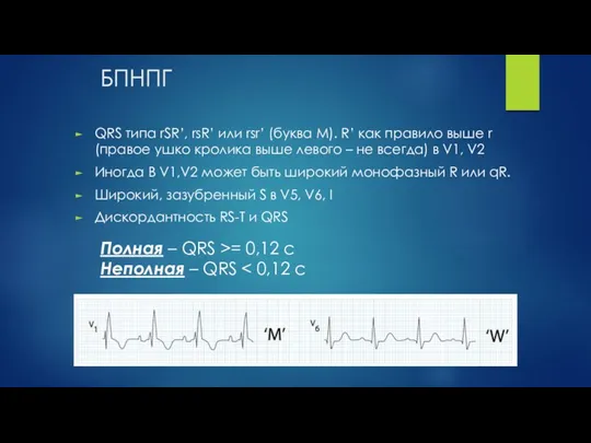 БПНПГ QRS типа rSR’, rsR’ или rsr’ (буква M). R’ как правило выше