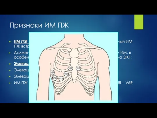 Признаки ИМ ПЖ ИМ ПЖ осложняет ДО 40 % нижних