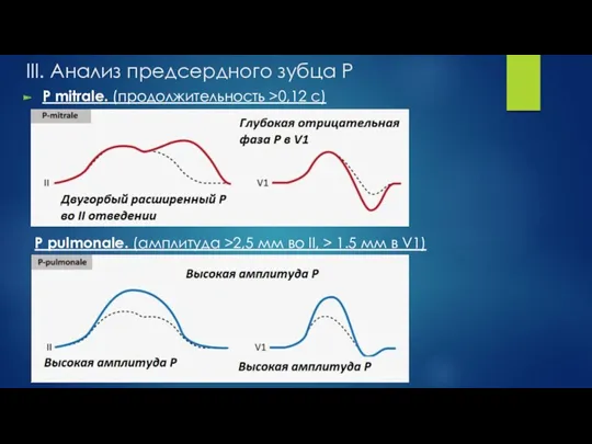 III. Анализ предсердного зубца P P mitrale. (продолжительность >0,12 с) P pulmonale. (амплитуда