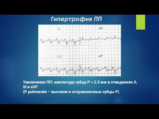 Гипертрофия ПП Увеличение ПП: амплитуда зубца P > 2.5 мм в отведениях II,