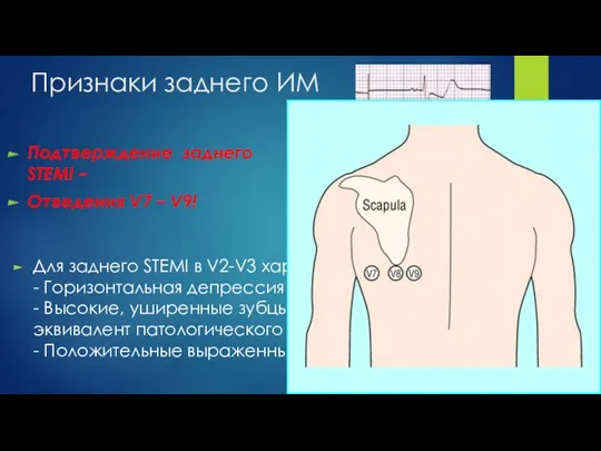 Признаки заднего ИМ Для заднего STEMI в V2-V3 характерно: - Горизонтальная депрессия ST;