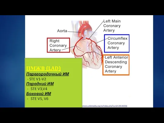 ПМЖВ (LAD) Перегородочный ИМ - STE V1-V2 Передний ИМ STE V3,V4 Боковой ИМ STE V5, V6
