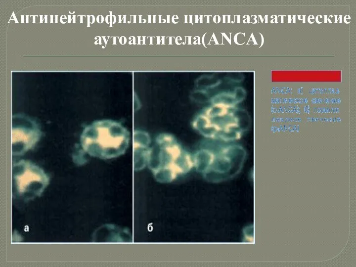 Антинейтрофильные цитоплазматические аутоантитела(ANCA)