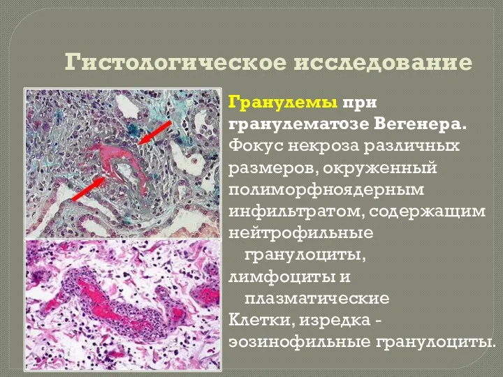 Гистологическое исследование Гранулемы при гранулематозе Вегенера. Фокус некроза различных размеров,