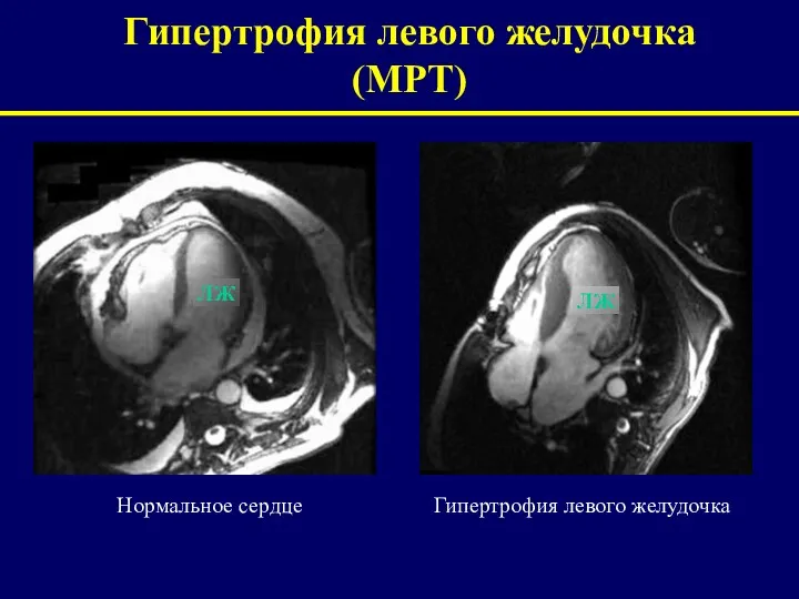 Нормальное сердце Гипертрофия левого желудочка ЛЖ ЛЖ Гипертрофия левого желудочка (МРТ)