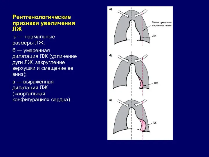 Рентгенологические признаки увеличения ЛЖ а — нормальные размеры ЛЖ; б