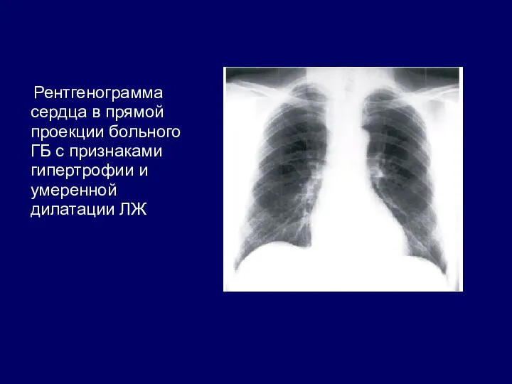 Рентгенограмма сердца в прямой проекции больного ГБ с признаками гипертрофии и умеренной дилатации ЛЖ