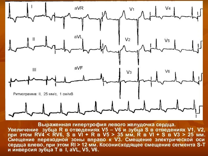 Выраженная гипертрофия левого желудочка сердца. Увеличение зубца R в отведениях