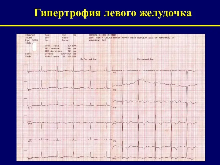 Гипертрофия левого желудочка