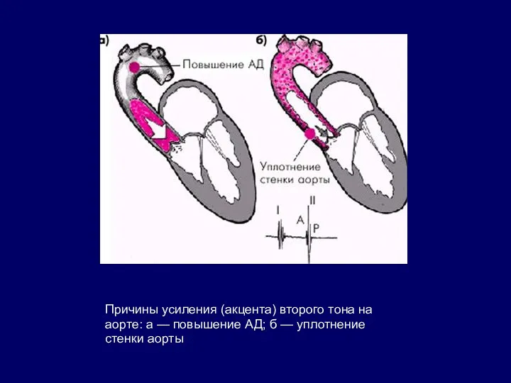 Причины усиления (акцента) второго тона на аорте: а — повышение АД; б — уплотнение стенки аорты
