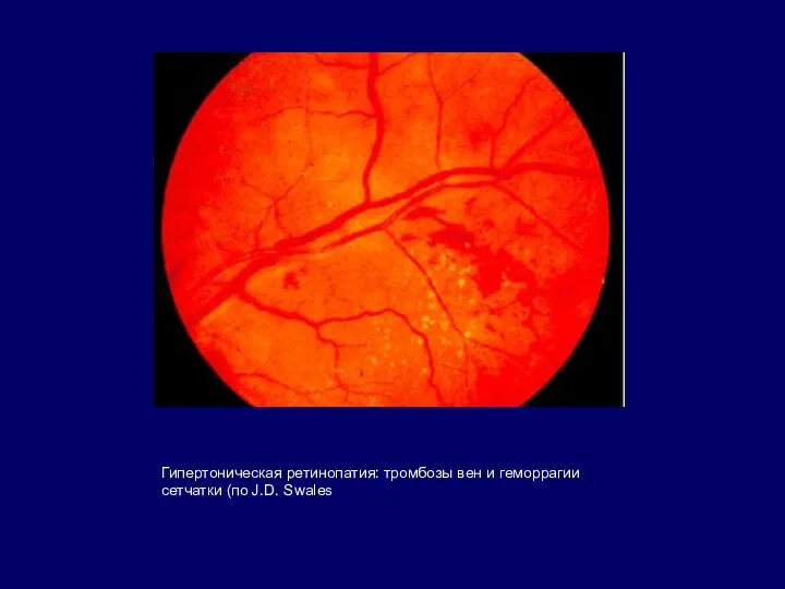 Гипертоническая ретинопатия: тромбозы вен и геморрагии сетчатки (по J.D. Swales