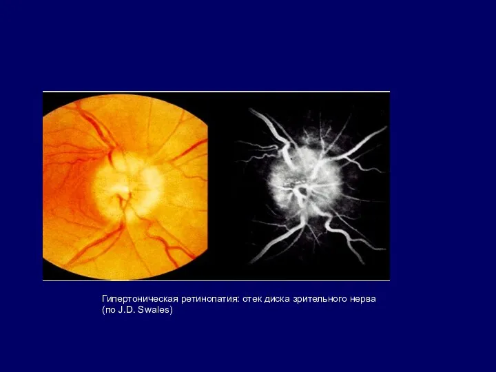 Гипертоническая ретинопатия: отек диска зрительного нерва (по J.D. Swales)