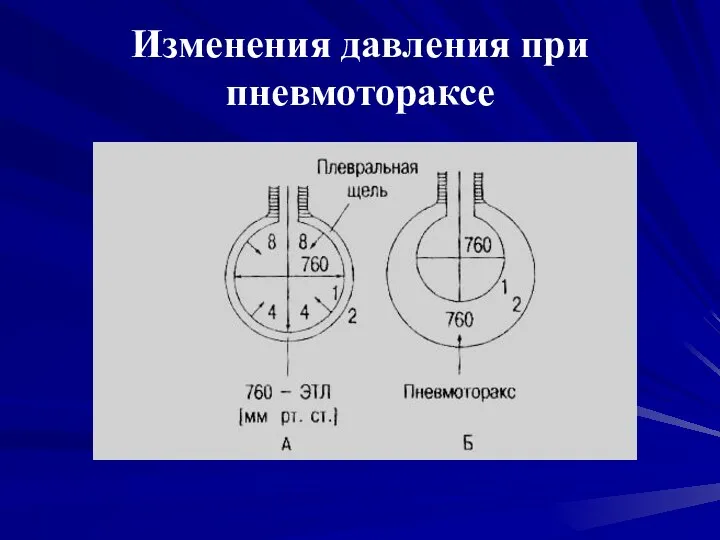 Изменения давления при пневмотораксе