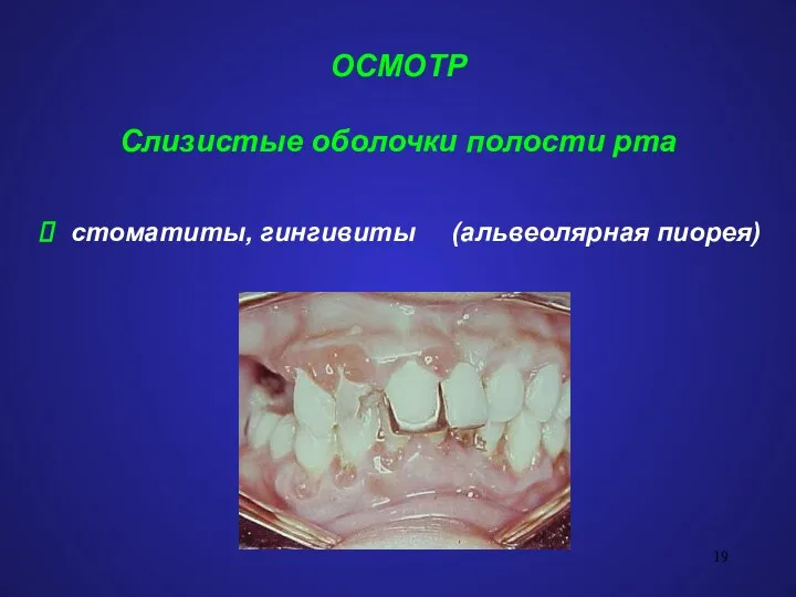 ОСМОТР Слизистые оболочки полости рта стоматиты, гингивиты (альвеолярная пиорея)