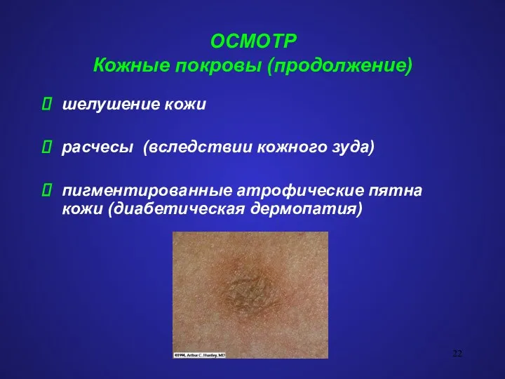 ОСМОТР Кожные покровы (продолжение) шелушение кожи расчесы (вследствии кожного зуда) пигментированные атрофические пятна кожи (диабетическая дермопатия)